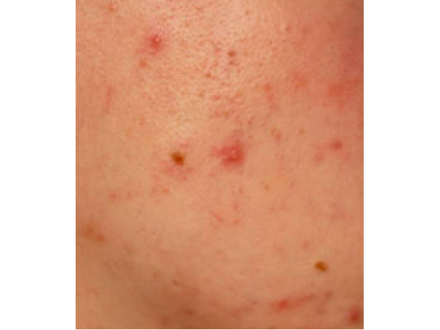 Acne care